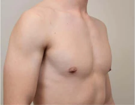 Gynecomastia Before & After Case 4865