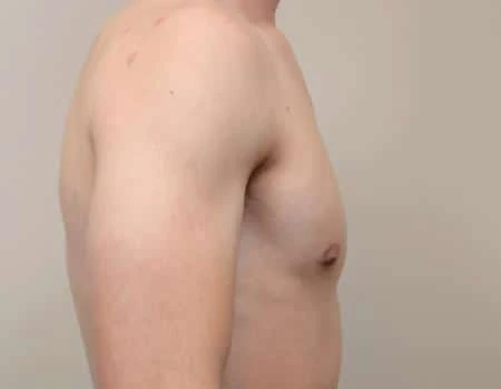 Gynecomastia Before & After Case 4865