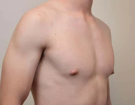 Gynecomastia Before & After Case 4865