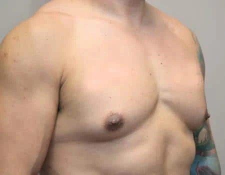 Gynecomastia Before & After Case 4858