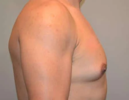 Gynecomastia Before & After Case 4858