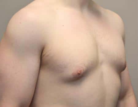 Gynecomastia Before & After Case 4835