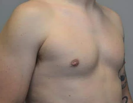Gynecomastia Before & After Case 4800
