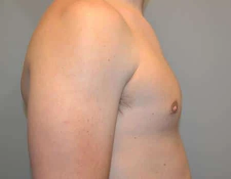 Gynecomastia Before & After Case 4800