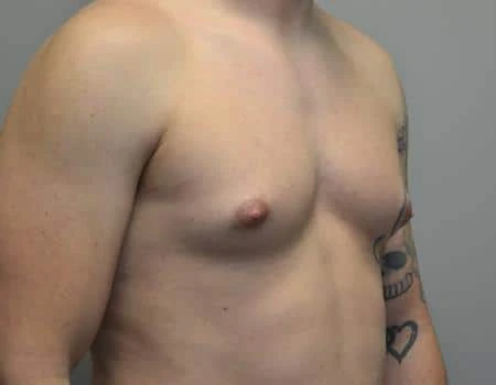 Gynecomastia Before & After Case 4800