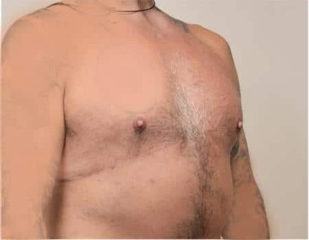 Gynecomastia Before & After Case 4974