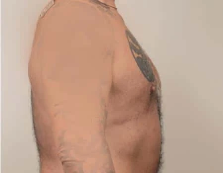 Gynecomastia Before & After Case 4974