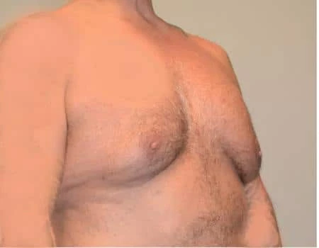 Gynecomastia Before & After Case 4974