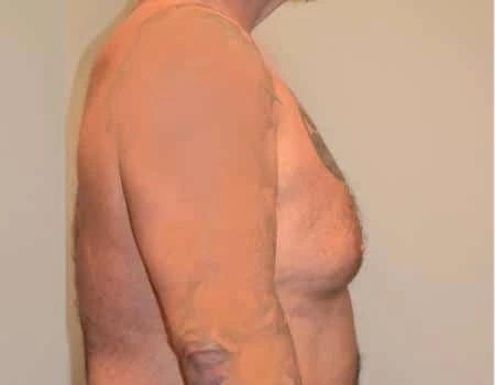 Gynecomastia Before & After Case 4974