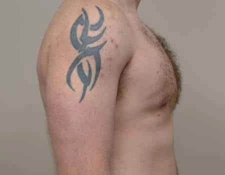 Gynecomastia Before & After Case 4959