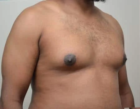 Gynecomastia Before & After Case 4951