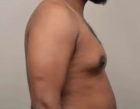 Gynecomastia Before & After Case 4951