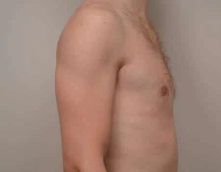 Gynecomastia Before & After Case 4944