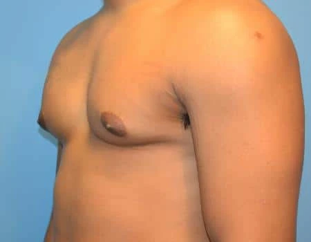 Gynecomastia Before & After Case 4997
