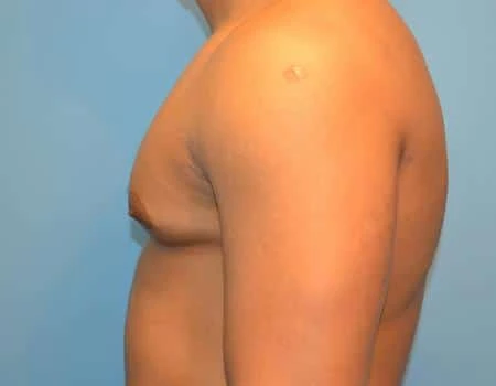 Gynecomastia Before & After Case 4997