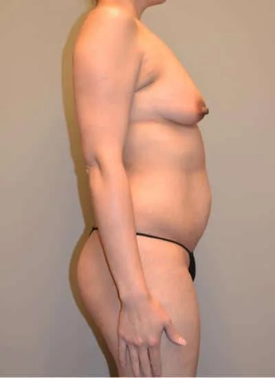 Mommy Makeover Before & After Case 4095