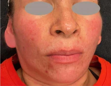 Microneedling-C1-B1