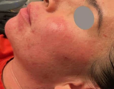 Microneedling Before & After Case 5384