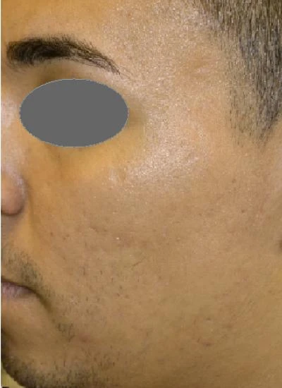 Microneedling Before & After Case 5389