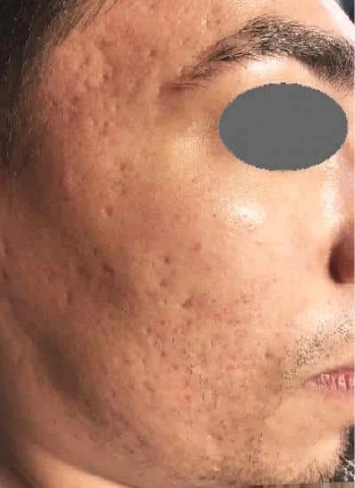 Microneedling-C2-B1