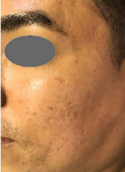 Microneedling Before & After Case 5389