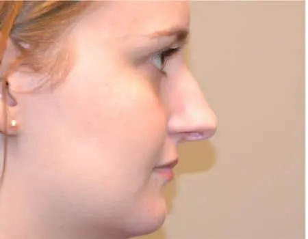 Rhinoplasty Before & After Case 5262