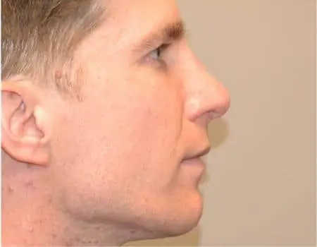 Rhinoplasty Before & After Case 5250