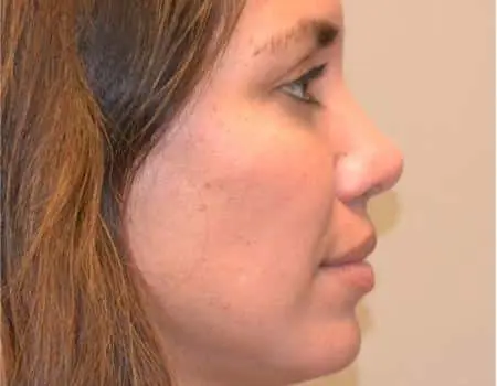 Rhinoplasty Before & After Case 5243