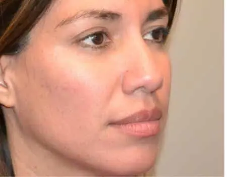 Rhinoplasty Before & After Case 5243