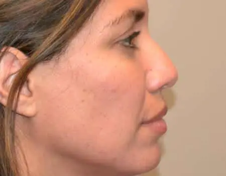 Rhinoplasty Before & After Case 5243