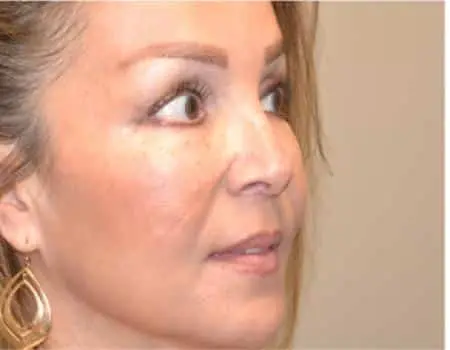 Rhinoplasty Before & After Case 5201