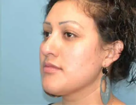 Rhinoplasty Before & After Case 5179