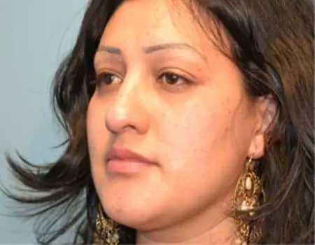 Rhinoplasty Before & After Case 5179