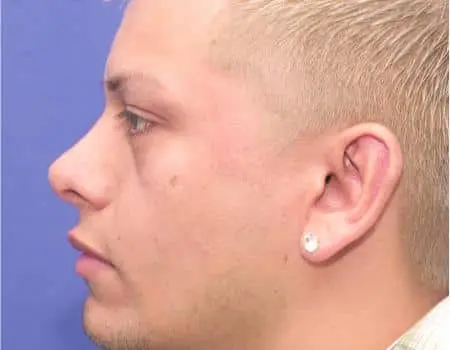 Rhinoplasty Before & After Case 5151