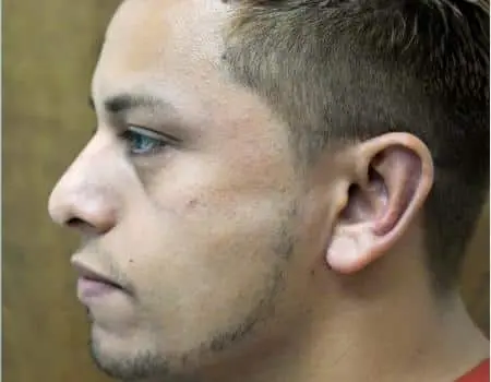 Rhinoplasty Before & After Case 5151