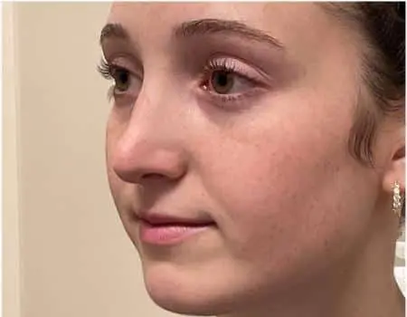 Rhinoplasty Before & After Case 5290