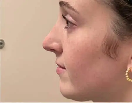 Rhinoplasty Before & After Case 5290