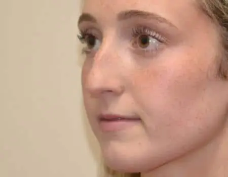 Rhinoplasty Before & After Case 5290