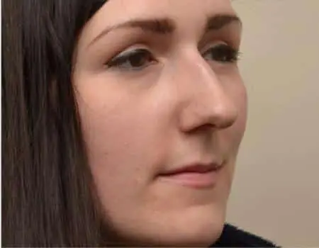 Rhinoplasty Before & After Case 5283