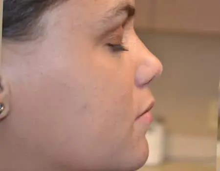 Rhinoplasty Before & After Case 5269