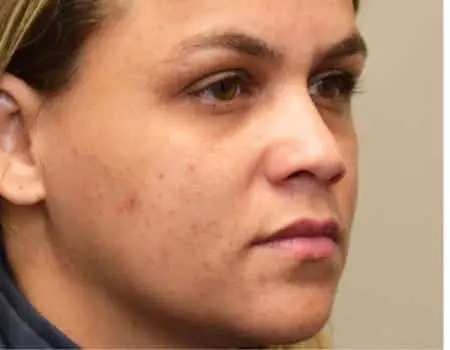 Rhinoplasty Before & After Case 5269