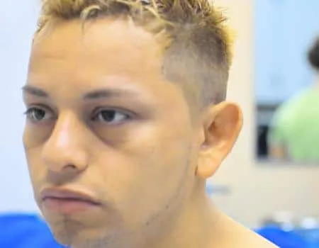 Ear Surgery (Otoplasty) Before & After Case 5136