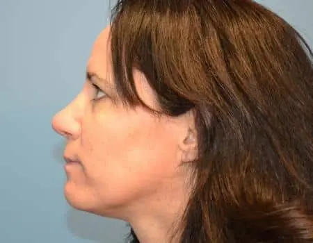Rhinoplasty Before & After Case 5326