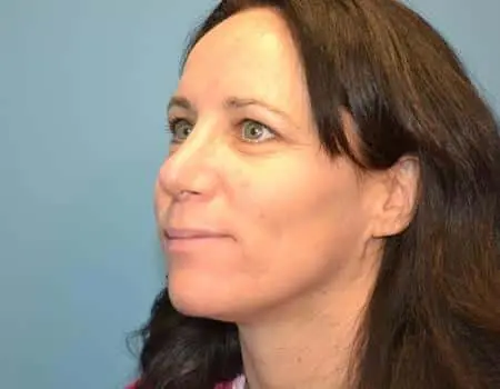 Rhinoplasty Before & After Case 5326