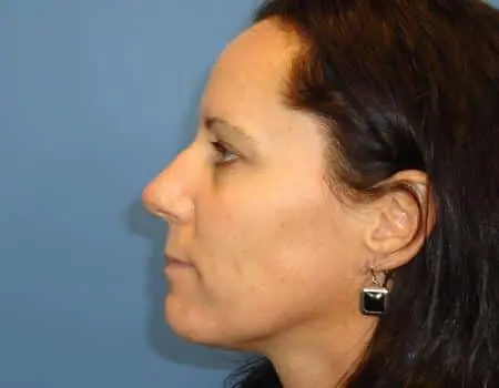 Rhinoplasty Before & After Case 5326