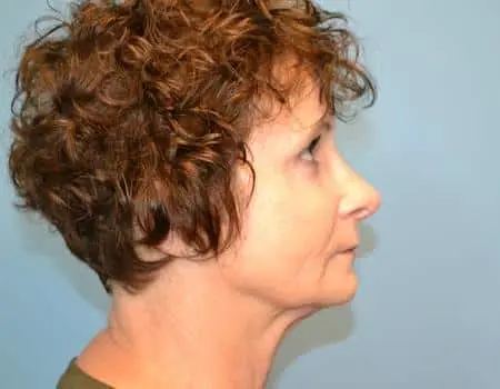 Rhinoplasty Before & After Case 5318