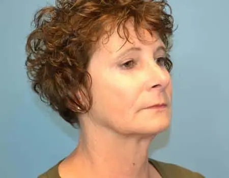 Rhinoplasty Before & After Case 5318