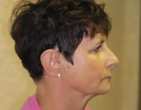 Rhinoplasty Before & After Case 5318
