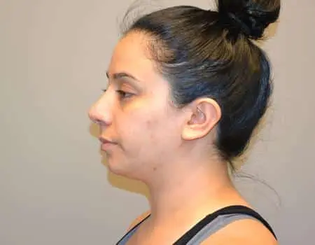 Rhinoplasty Before & After Case 5311