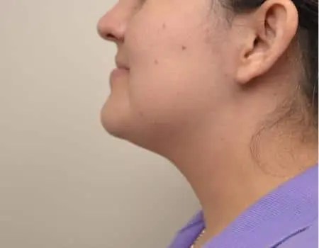 Smartlipo Before & After Case 4295